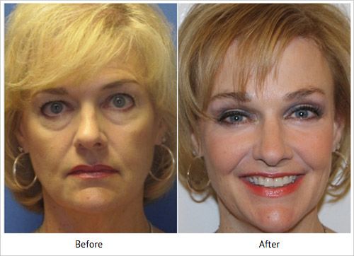 Devlin Cosmetic Surgery patient before and after injectable fillers