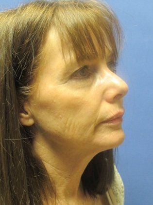 Devlin Cosmetic Surgery patient before and after fat grafting