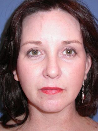 After Chemical Peel treatment image