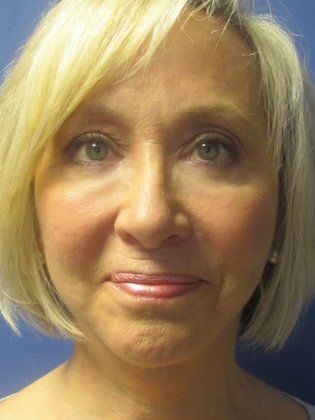 After photo of a woman who was seeking Facelift Surgeons in Little Rock, AR and had the RestoreLift Facelift by Dr. Michael Devlin