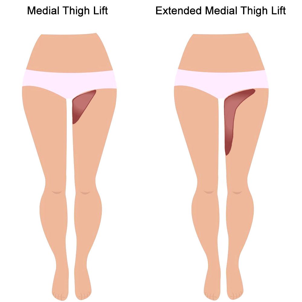 Illustration of thigh lift techniques